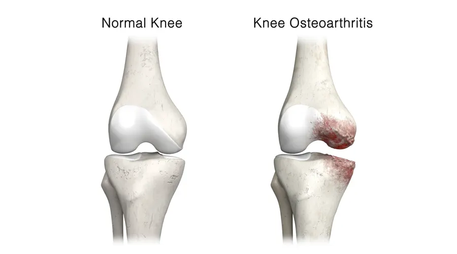 Osteoarthritis